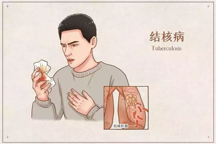 肺结核饮食减肥法——健康减肥的正确方式(1)