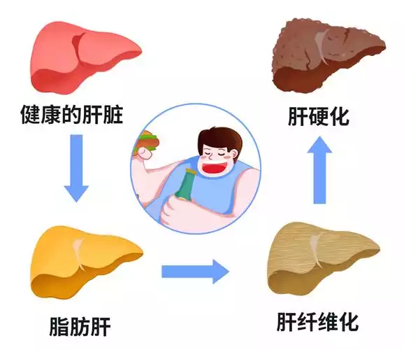 减肥过快导致脂肪肝原因及预防方法(1)